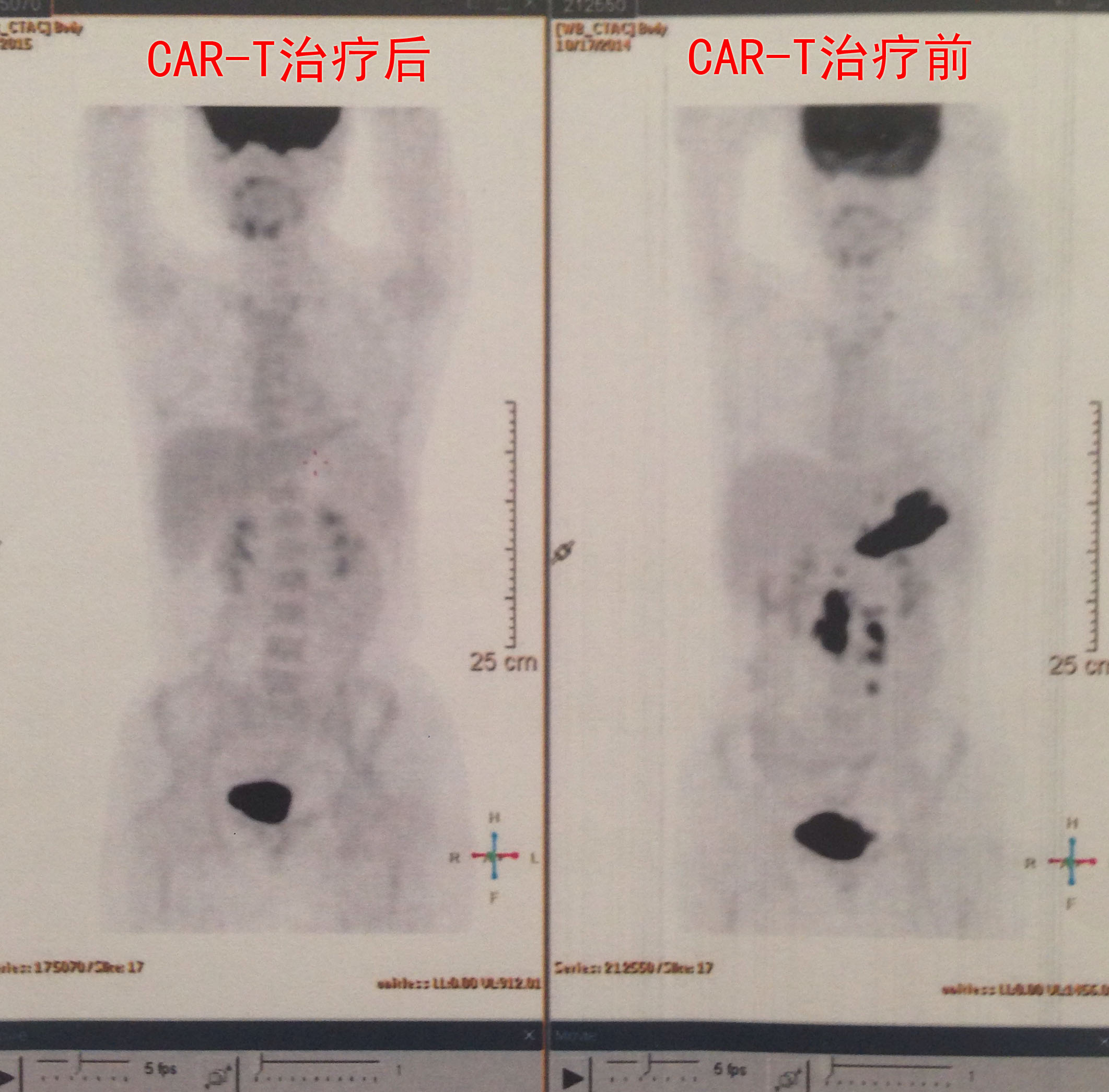 CAR-T完全缓解