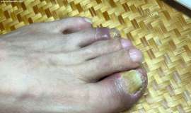【求助】截至2024.8月一年半多使用k药，出现脚趾头手指头红肿。
