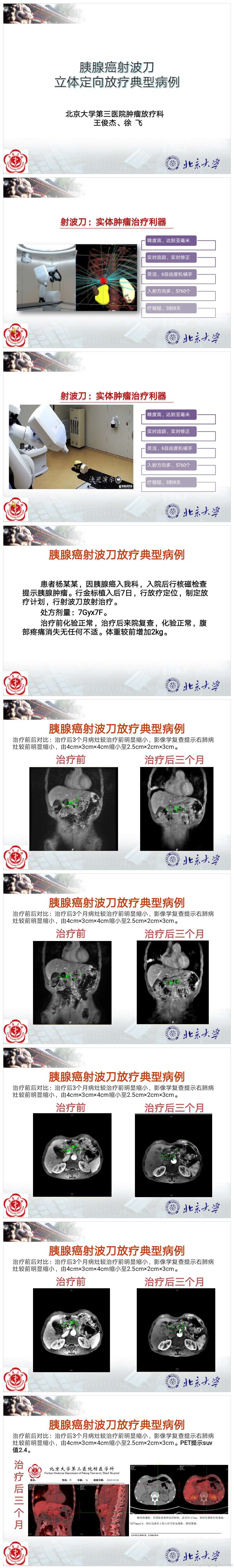 胰腺癌射波刀立体定向放疗典型病例.jpg